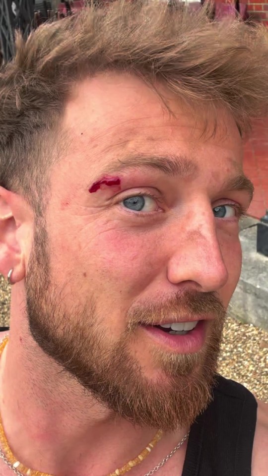 Sam Thompson with a bleeding cut above his eyebrow.