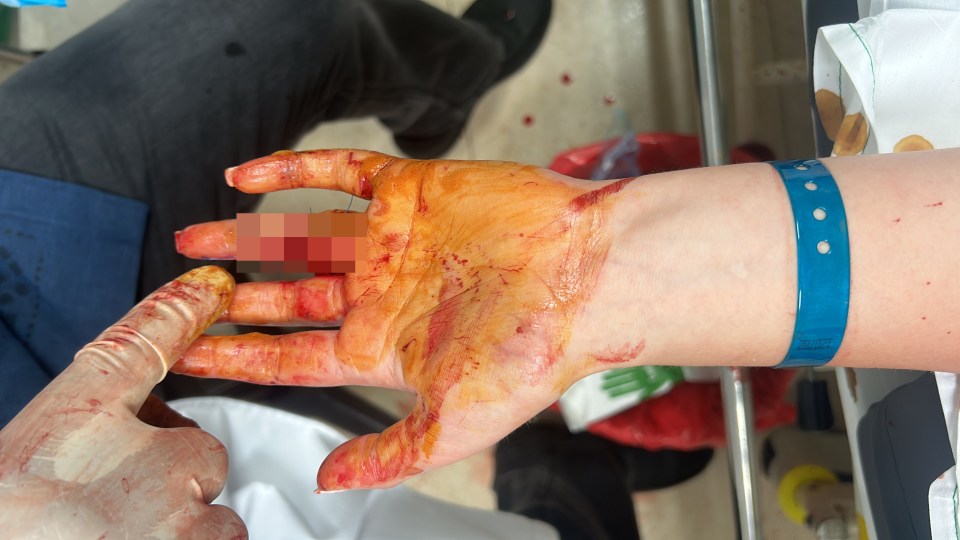 Severely injured hand with a deep wound on the ring finger.