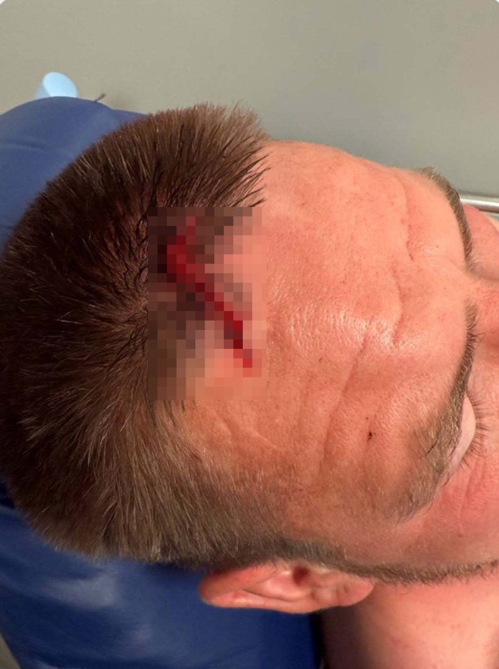 Close-up of a man's head wound.