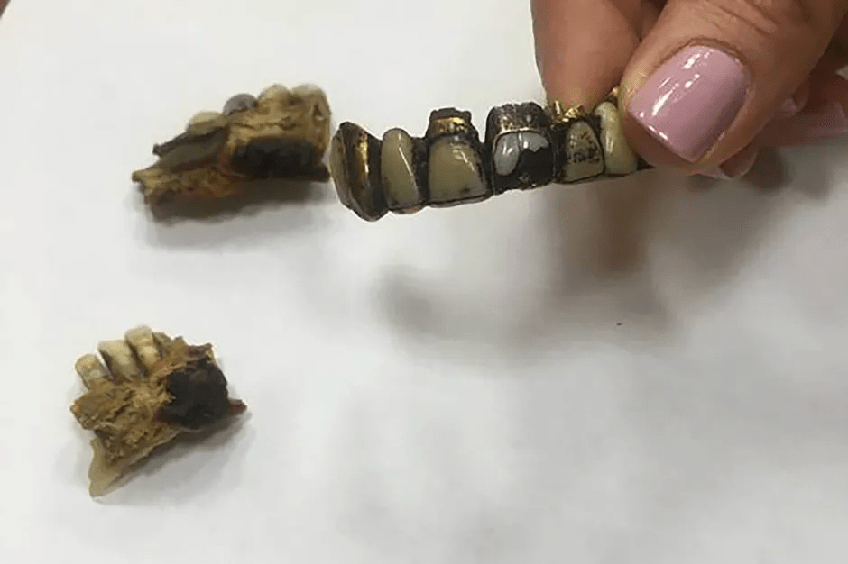 Gold-inlaid teeth.