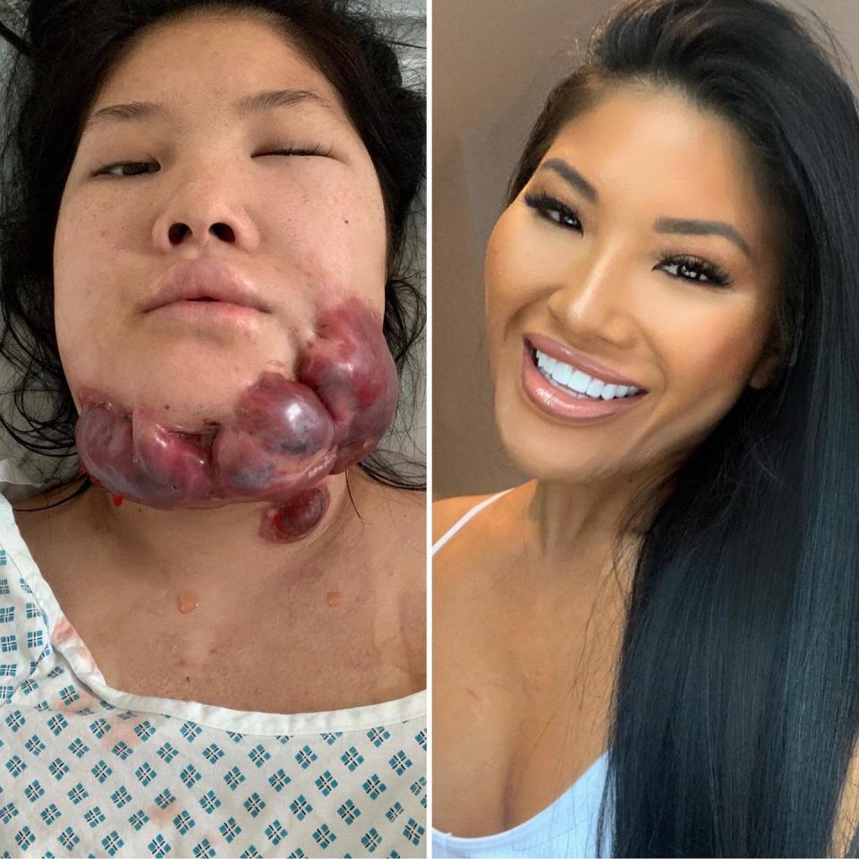 Before and after photos of a woman's jaw surgery.