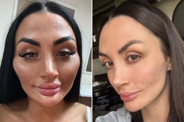 An image collage containing 2 images, Image 1 shows Close-up selfie of a woman with noticeable facial fillers, captioned "Until I remember how bad my filler blindness was.", Image 2 shows Close-up of a woman's face after dissolving lip, cheek, and chin filler