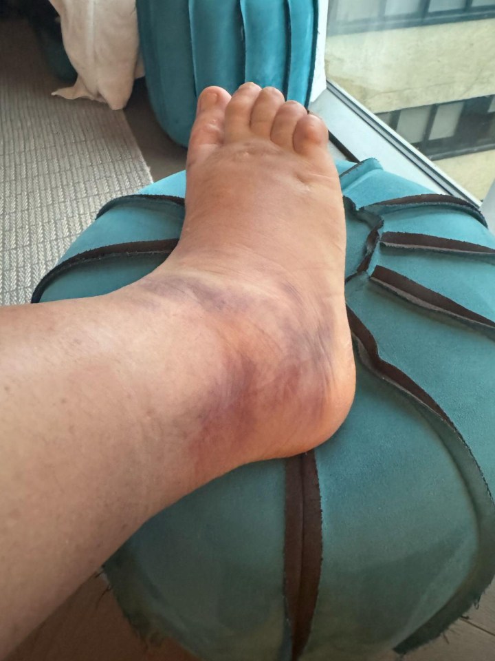 Bruised ankle resting on a teal cushion.